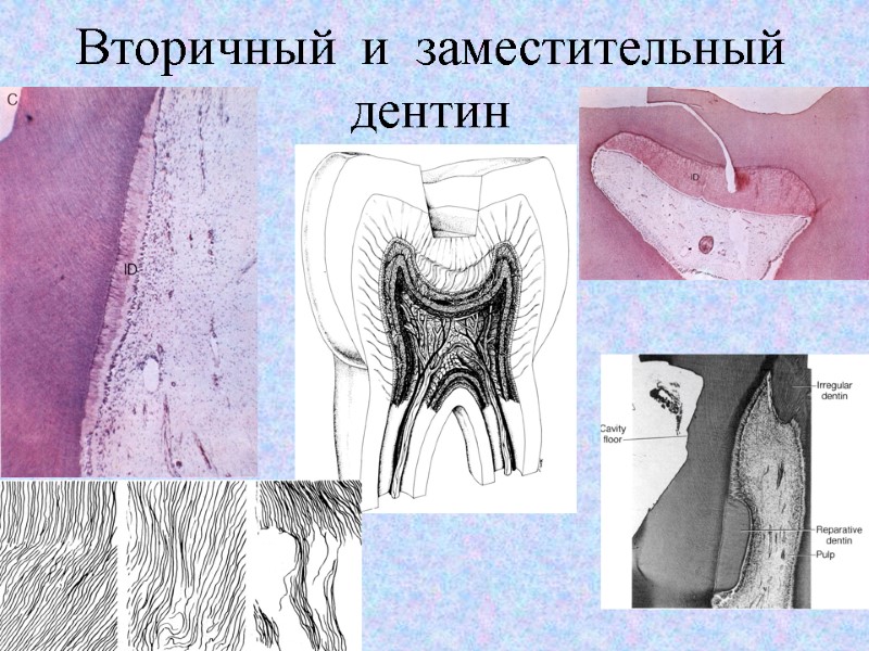 Вторичный  и  заместительный дентин